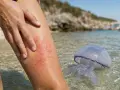 Gamba con eritema da puntura di medusa. Cosa fare in caso di contatto con questi organismi marini.