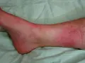 Rotes, entzündetes Bein mit deutlicher Rötung und kleinen Pusteln, die auf eine Wundrose hindeuten.