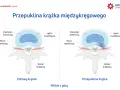 Porównanie zdrowego krążka międzykręgowego z przepukliną krążka szyjnego z uciskiem na worek oponowy.