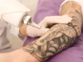 Ręka w rękawiczce trzyma laser do usuwania tatuażu z ręki.