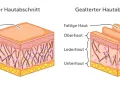 Vergleich von junger, glatter Haut und gealterter, faltiger Haut. Die Lederhaut zeigt bei trockene Haut im Alter weniger Kollagenfasern.