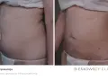 Liposukcja: Czy to dla Ciebie? Rodzaje, efekty, koszty - poradnik