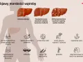 Ilustracja pokazuje zdrowe i chore wątroby, a także objawy marskości wątroby: ból brzucha, zmęczenie, utratę masy ciała, żółtaczkę, obrzęki, gorączkę i zmiany skórne.