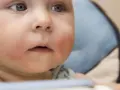 Czerwone, suche plamy na policzkach dziecka mogą świadczyć o uczuleniu na nabiał. Twarz malucha jest zaczerwieniona.