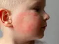Czerwone policzki u dziecka, widoczny rumień.