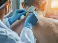 Dermatolog w rękawiczkach bada powiększoną lupą skórę szyi pacjenta z licznymi włókniakami.