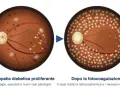 Retinopatia diabetica proliferante con emorragie e essudati, prima e dopo il trattamento laser che riduce la lesione retinica.