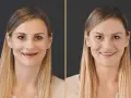Przed i po zabiegu bonding zębów. Uśmiech kobiety po poprawie estetyki uzębienia.