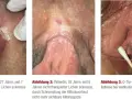Drei Bilder zeigen die Auswirkungen von Lichen sclerosus: eine entzündete Vulva, eine geschrumpfte Klitoris und einen Q-Tip-Test.