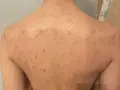 Rygg med utslag av akne på kroppen. Röda prickar och fläckar syns över hela ryggen.