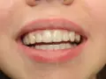 Zbliżenie na uśmiech z widocznymi przezroczystymi nakładkami Invisalign na zębach.