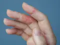 Dedos con piel irritada y escamosa, indicando un fuerte picor en las manos.