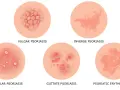 Ilustracja pokazuje różne typy łuszczycy: łuszczycę zwykłą, łuszczycę odwróconą, łuszczycę krostkową, łuszczycę plamistą i łuszczycę erytrodermiczną.