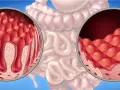 Zöliakie Diagnostik: So vermeiden Sie Fehldiagnosen und Schmerzen