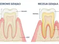 Zdrowe dziąsło vs recesja dziąsła. Recesja powoduje odsłonięcie korzenia i może prowadzić do bólu dziąsła między zębami.