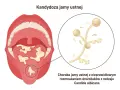 Ilustracja przedstawia jamę ustną z białymi nalotami na języku i podniebieniu, co jest objawem grzybicy jamy ustnej. Powiększony fragment ukazuje drożdżaki Candida albicans.