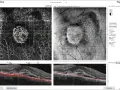 Immagine OCT di un occhio destro, mostra un ispessimento retinico con neovascolarizzazione coroideale, possibile causa di problemi visivi.
