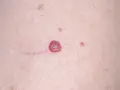 Piel con varios lunares rojos de diferentes tamaños, algunos pequeños y otros más prominentes, junto a finas venas.