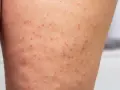 Eingewachsenes Haar am Bein: Ursachen, Behandlung und Vorbeugung