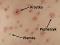 Początki ospy: czerwone plamki, krostki i pęcherzyki na skórze.