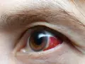 Occhio con forte arrossamento, possibile sintomo di complicanze del diabete.