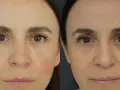 Nahaufnahme zweier Gesichter, die die Entwicklung von reifer Haut ab wann zeigen. Falten um die Augen und auf der Stirn sind sichtbar.