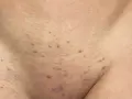 Red bumps and irritation on the skin, indicative of folliculitis and a histamine reaction after waxing.