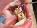 Dentysta używa narzędzia do leczenia zęba, co na bolący ząb?