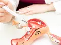 Lekarz wskazuje na model macicy, gdzie widoczny jest polip endometrialny.
