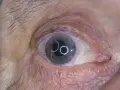 Occhio con iride verde-grigia e riflessi luminosi. Si nota una piccola apertura nell'iride, tipica di un intervento di iridectomia cos'è.