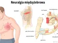 Ilustracja przedstawia mężczyznę z bólem w klatce piersiowej, wskazującym na neuralgia potyliczna objawy. Pokazuje unerwienie żeber i kręgosłupa.