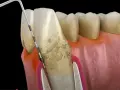 Model stomatologiczny pokazujący postępujące choroby dziąseł, z widocznym kamieniem nazębnym i narzędziem dentystycznym.