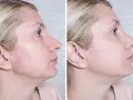 Przed i po: skóra z niedoskonałościami i zaczerwienieniami (acne) po zastosowaniu produktu, który wyrównał koloryt i wygładził cerę.