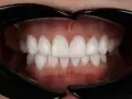 Piękne, białe zęby po zabiegu dental bonding. Uśmiech jak z reklamy!
