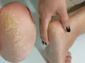 Popękane, suche pięty wymagają nawilżenia. Zobacz, co na suche pięty pomoże.