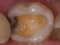 Czy dziura w zębie zarasta sama? Prawda o naturalnym gojeniu