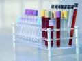 Rurki z krwią w stojaku laboratoryjnym. Czy to badanie CA 125?