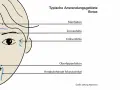 Schema zeigt typische Anwendungsgebiete für Botox, z.B. Stirnfalten, Zornesfalten, Krähenfüße.