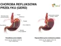 Ilustracja pokazuje prawidłowe i nieprawidłowe działanie żołądka, wyjaśniając objawy refluksu.