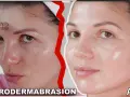 Woman using a microdermabrasion device on her forehead. Learn how to clean microdermabrasion tips for best results.