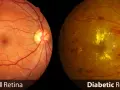 Confronto tra retina sana e retina diabetica: la seconda mostra emorragie e depositi gialli, sintomi della retinopatia diabetica.