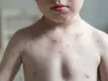 Kind mit roten Pusteln am Oberkörper und Hals. Die Haut wirkt blass, was Fragen aufwirft: "Warum ist mein Kind so blass?