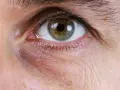 Eisenmangel symptome augen: Dunkle Augenringe und ihre Ursachen erkennen