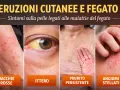 Eruzioni cutanee e ittero: la pelle mostra macchie rosse, una protuberanza cutanea pruriginosa e angiomi stellati, sintomi legati a malattie del fegato.