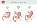 Ilustracja porównuje trzy typy operacji bariatrycznych: GS, RYGB, OAGB. Dowiedz się, ile kosztuje operacja bariatryczna i jakie są jej rodzaje.