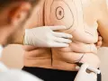 Liposukcja: Co to jest? Zrozum zabieg modelowania sylwetki