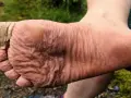 Fuß mit Blasenpflaster am Zeh, um Blasen vorzubeugen. Die Haut ist zerknittert vom Wandern.