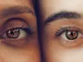Dos ojos de cerca, uno con ojeras vasculares marcadas, el otro con piel lisa. Reflejos en los iris.