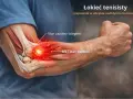 Anatomia łokcia z zaznaczonym stanem zapalnym ścięgien i bólem, wskazującym na łokieć tenisisty.
