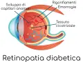 Illustrazione della retinopatia diabetica: sviluppo di capillari anomali, rigonfiamenti, emorragie retiniche che si riassorbono e tessuto cicatriziale.